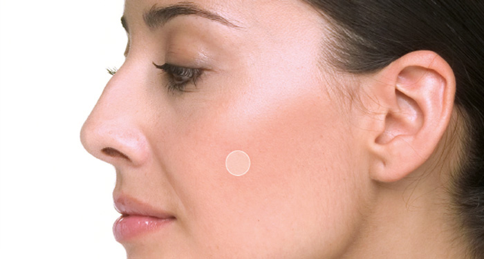 Acne Patch