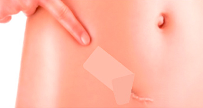 Scar Reducer Polyurethane Patch